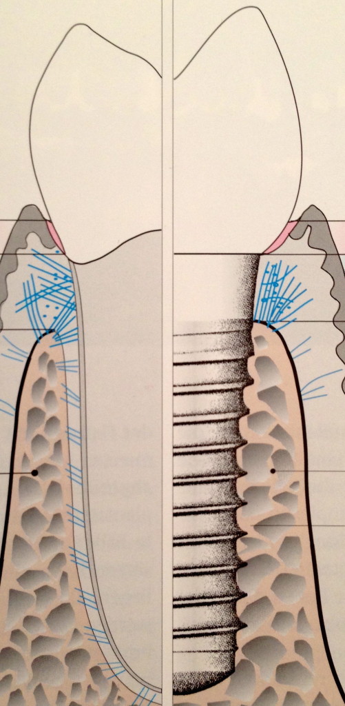 Zahn vs. Implantat 1